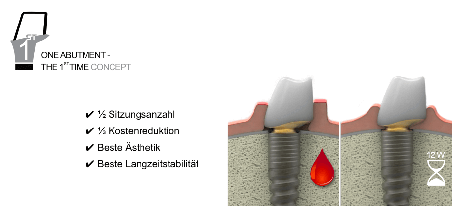 One Abutment - The 1st Time